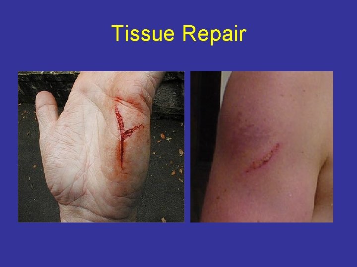 Tissue Repair 