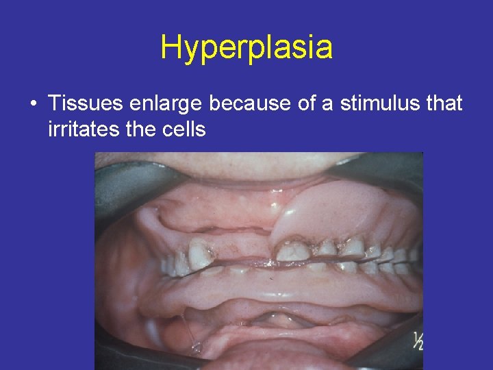 Hyperplasia • Tissues enlarge because of a stimulus that irritates the cells 