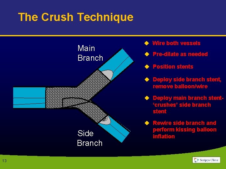 The Crush Technique Main Branch u Wire both vessels u Pre-dilate as needed u