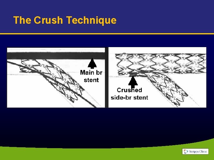 The Crush Technique 