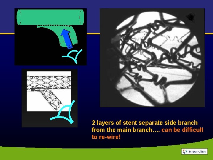 2 layers of stent separate side branch from the main branch…. can be difficult