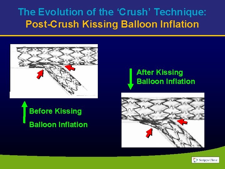 The Evolution of the ‘Crush’ Technique: Post-Crush Kissing Balloon Inflation After Kissing Balloon Inflation