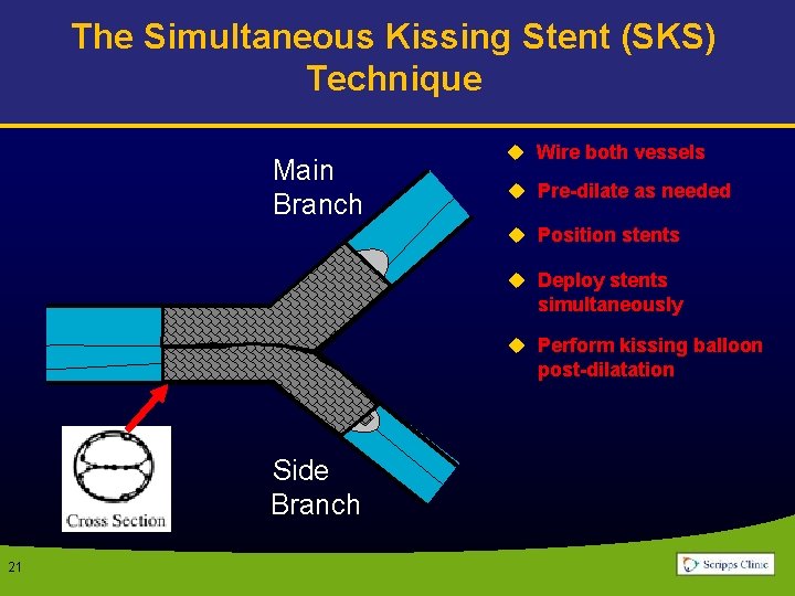 The Simultaneous Kissing Stent (SKS) Technique Main Branch u Wire both vessels u Pre-dilate