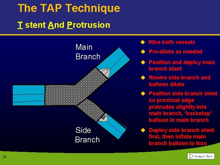 The TAP Technique T stent And Protrusion Main Branch u Wire both vessels u