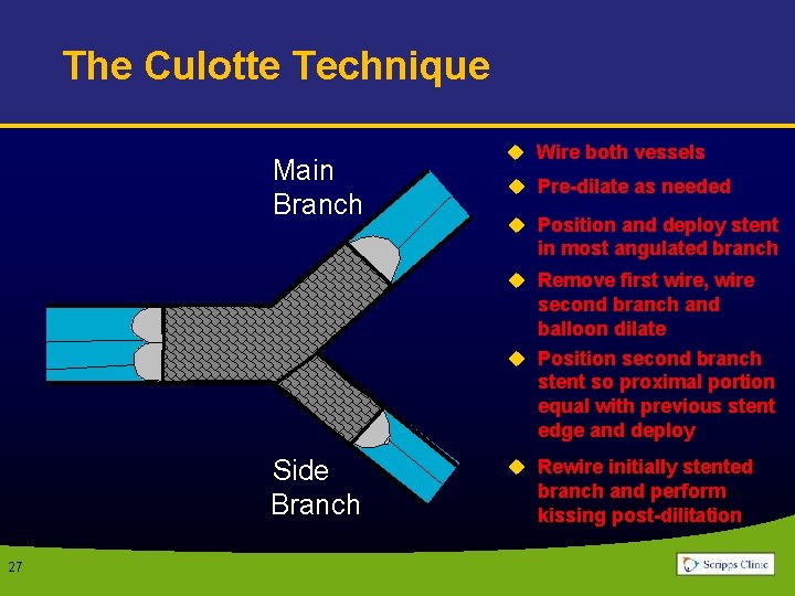 The Culotte Technique Main Branch u Wire both vessels u Pre-dilate as needed u