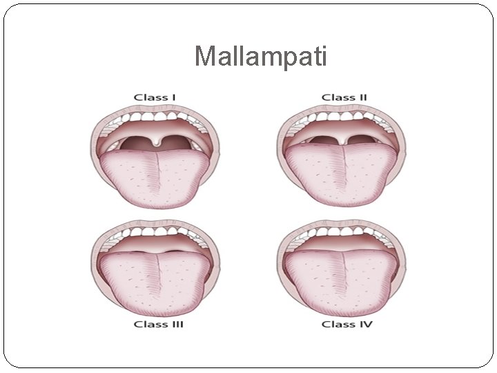 Mallampati 