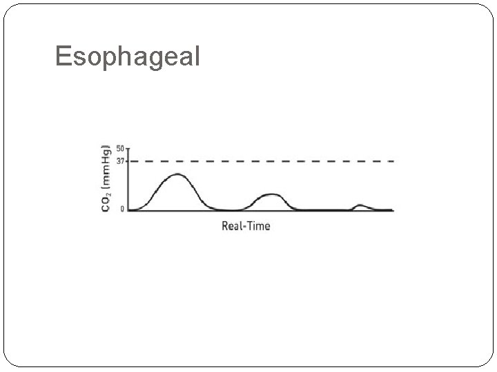 Esophageal 