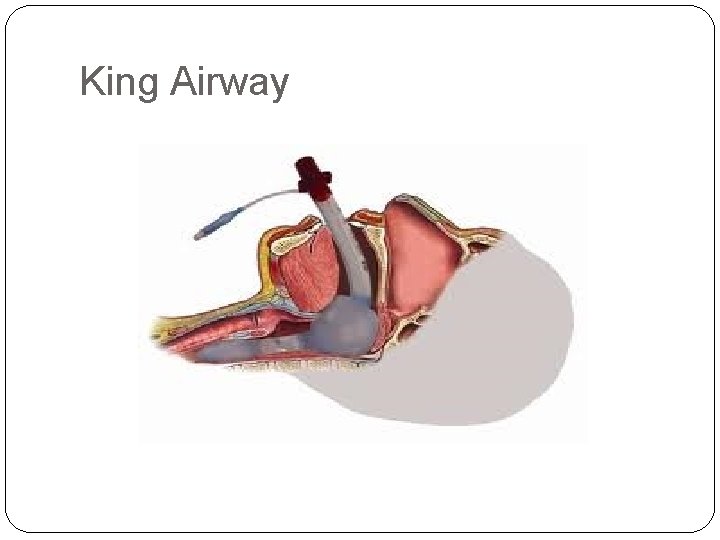 King Airway 