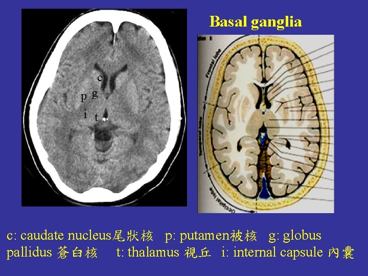 Basal ganglia c pg i t c: caudate nucleus尾狀核 p: putamen被核 g: globus pallidus Basal ganglia c pg i t c: caudate nucleus尾狀核 p: putamen被核 g: globus pallidus