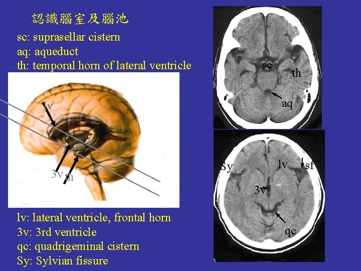 認識腦室及腦池 sc: suprasellar cistern aq: aqueduct th: temporal horn of lateral ventricle sc aq