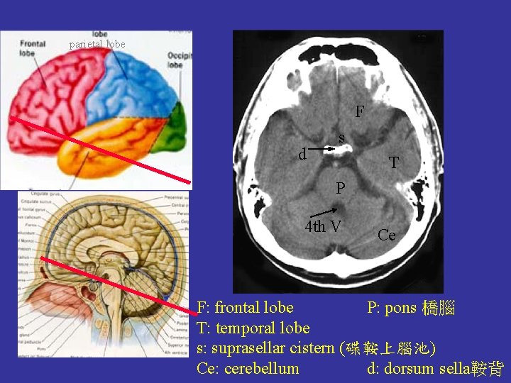 parietal lobe F d s T P 4 th V Ce F: frontal lobe