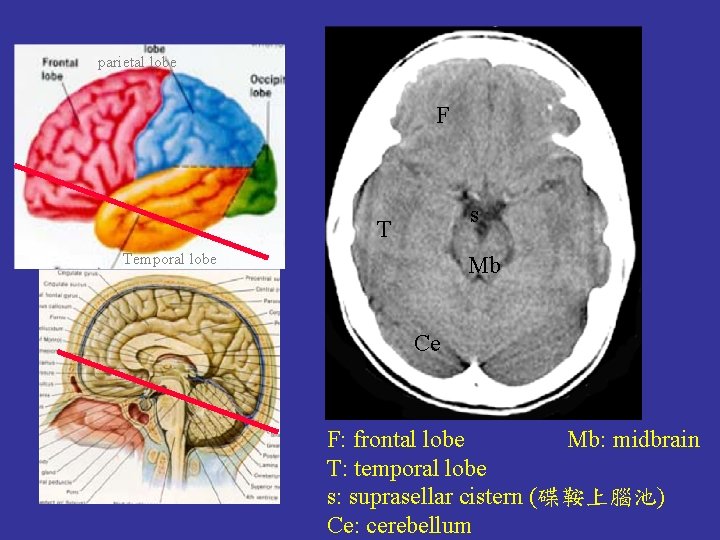 parietal lobe F s T Temporal lobe Mb Ce F: frontal lobe Mb: midbrain