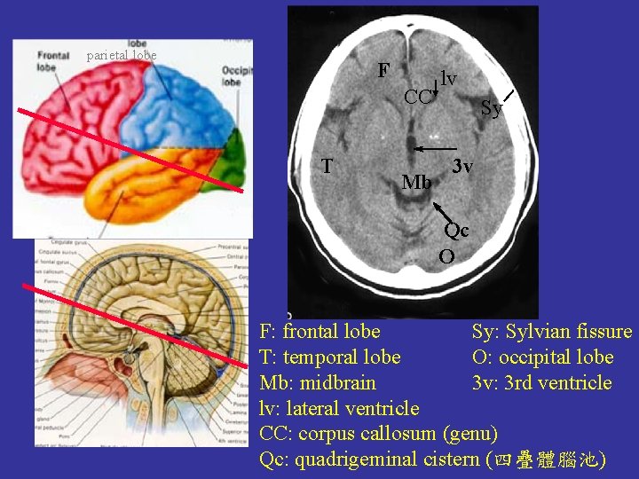 parietal lobe F CC T Mb lv Sy 3 v Qc O F: frontal