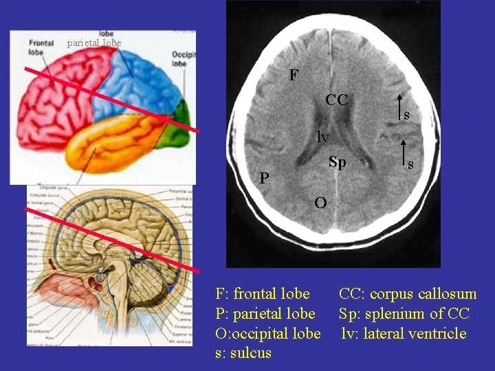 parietal lobe F CC s lv Sp P s O F: frontal lobe P: