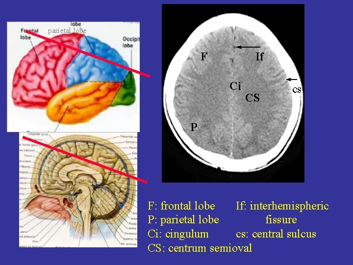 parietal lobe F If Ci CS cs P F: frontal lobe If: interhemispheric P: