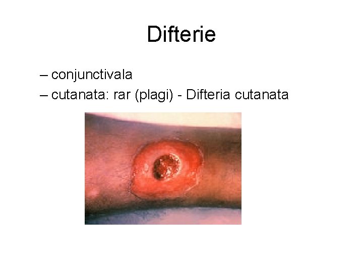 Difterie – conjunctivala – cutanata: rar (plagi) - Difteria cutanata 
