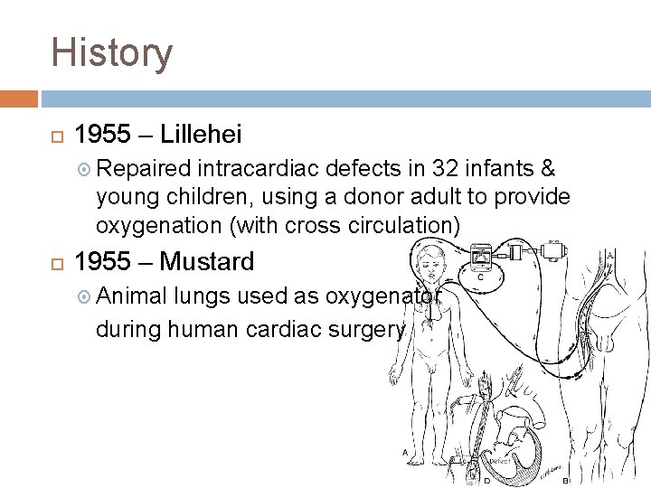 History 1955 – Lillehei Repaired intracardiac defects in 32 infants & young children, using
