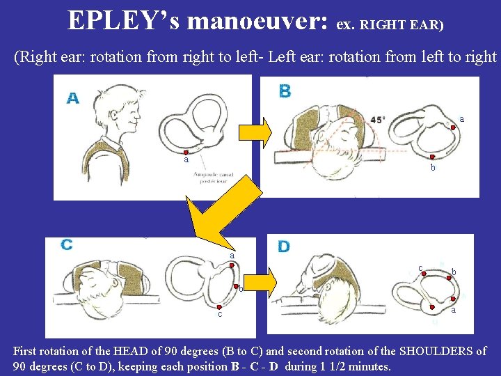 EPLEY’s manoeuver: ex. RIGHT EAR) (Right ear: rotation from right to left- Left ear: