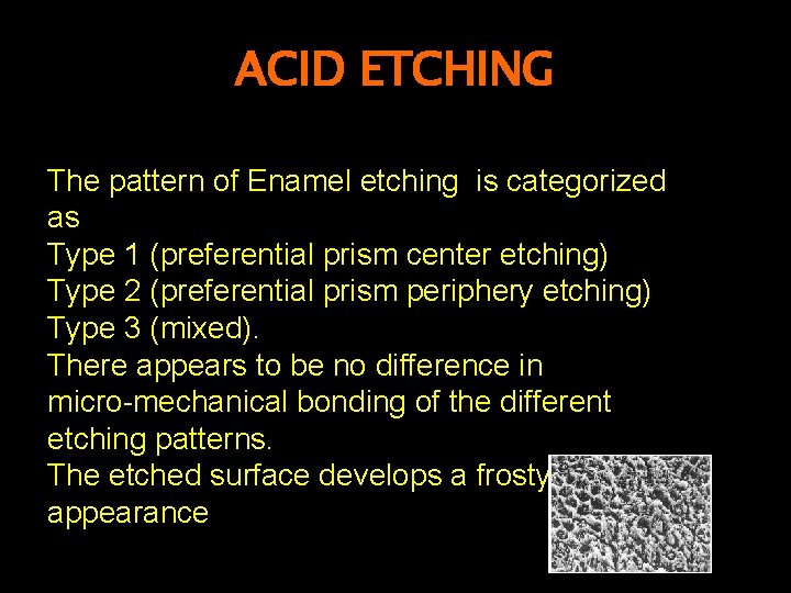 ACID ETCHING The pattern of Enamel etching is categorized as Type 1 (preferential prism