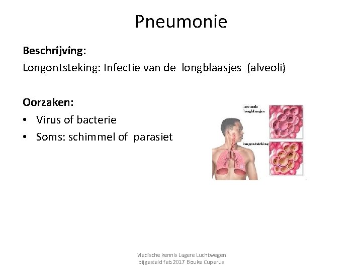 Pneumonie Beschrijving: Longontsteking: Infectie van de longblaasjes (alveoli) Oorzaken: • Virus of bacterie •