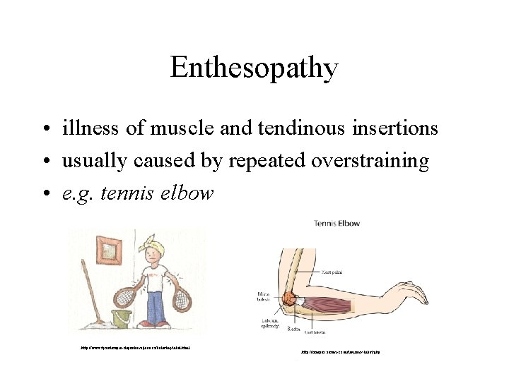 Enthesopathy • illness of muscle and tendinous insertions • usually caused by repeated overstraining