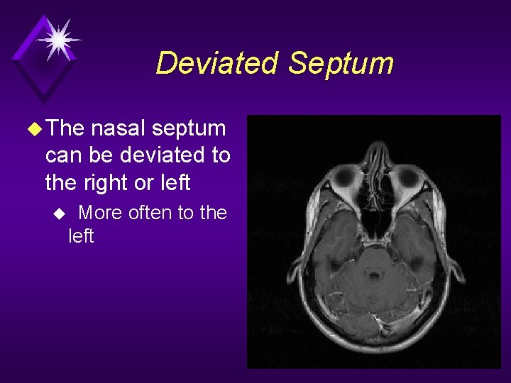 Deviated Septum u The nasal septum can be deviated to the right or left