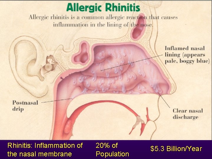 Rhinitis: Inflammation of the nasal membrane 20% of Population $5. 3 Billion/Year 