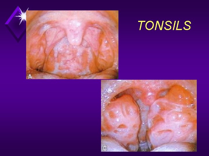 TONSILS 