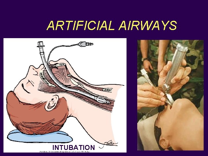 ARTIFICIAL AIRWAYS INTUBATION 