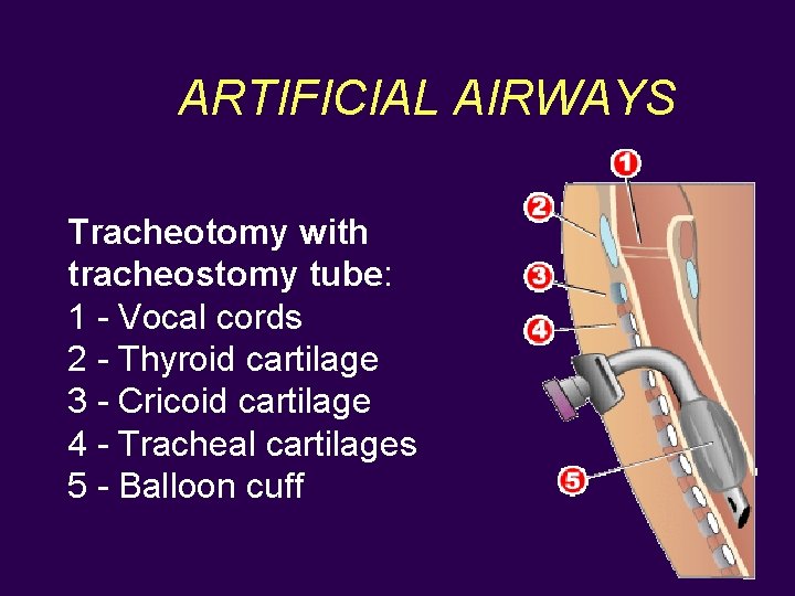ARTIFICIAL AIRWAYS Tracheotomy with tracheostomy tube: 1 - Vocal cords 2 - Thyroid cartilage