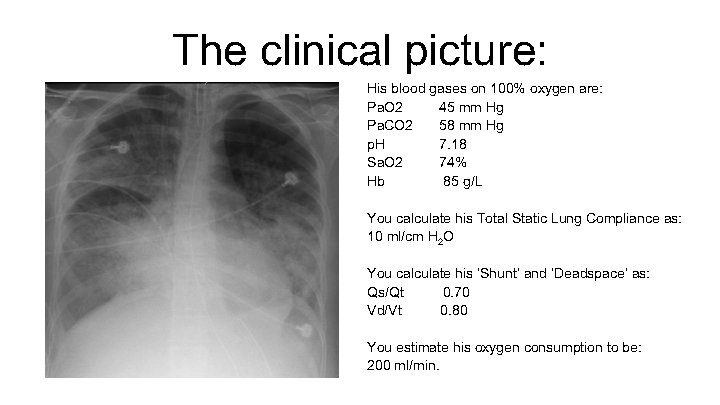 The clinical picture: His blood gases on 100% oxygen are: Pa. O 2 45