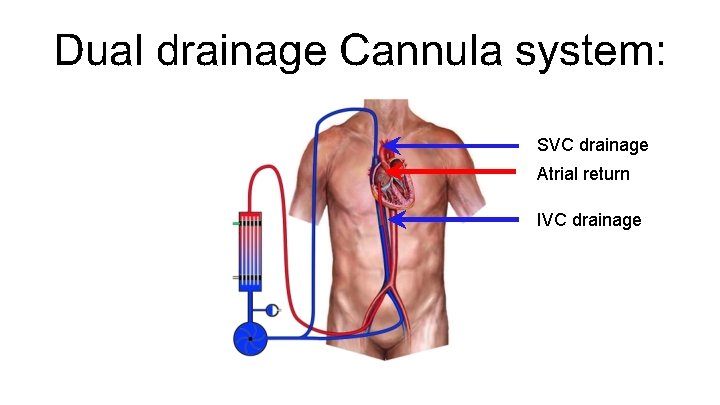 Dual drainage Cannula system: SVC drainage Atrial return IVC drainage 
