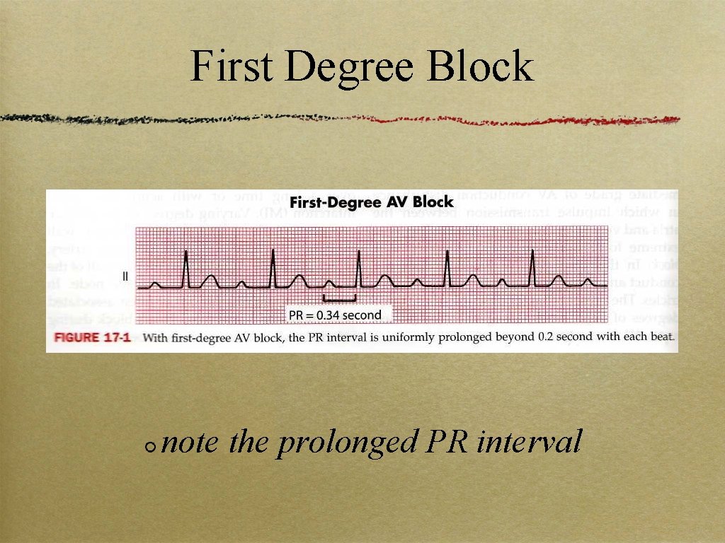 First Degree Block note the prolonged PR interval 