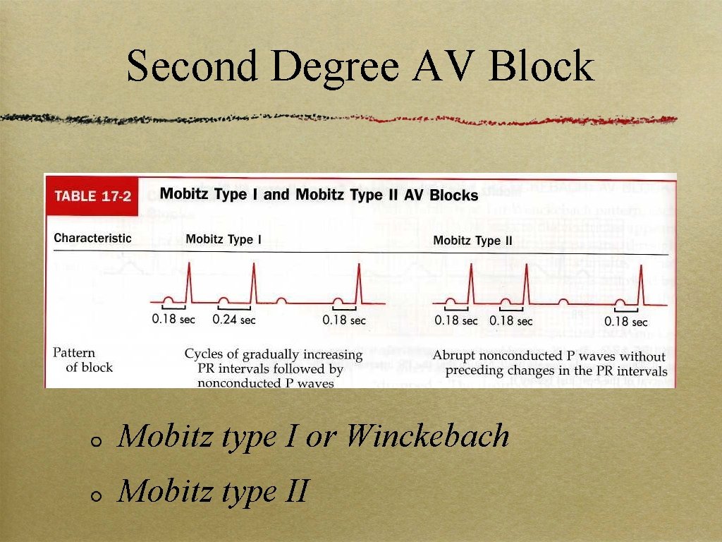 Second Degree AV Block Mobitz type I or Winckebach Mobitz type II 