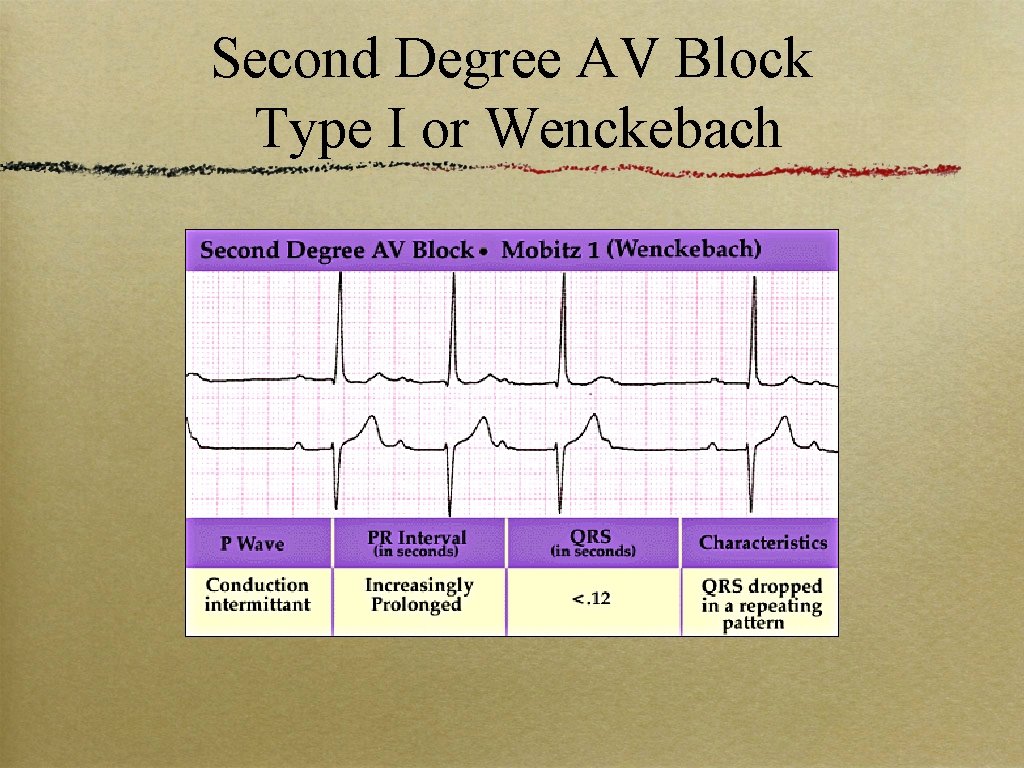Second Degree AV Block Type I or Wenckebach 