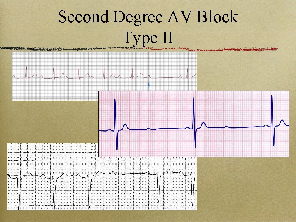 Second Degree AV Block Type II 