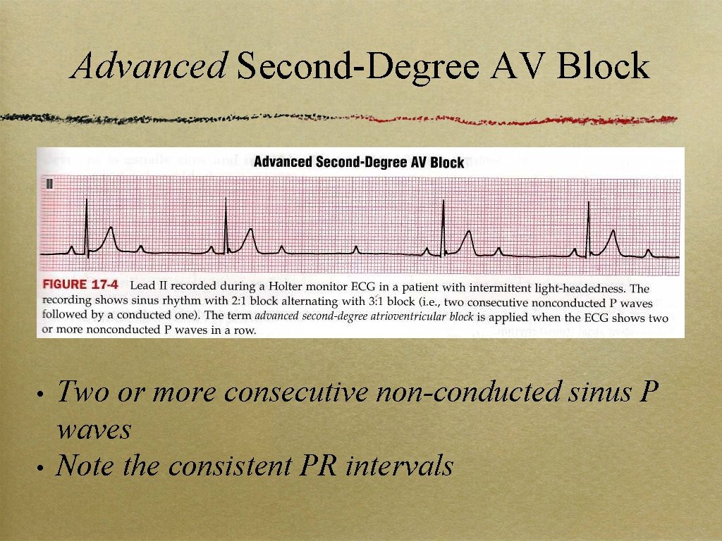 Advanced Second-Degree AV Block • • Two or more consecutive non-conducted sinus P waves