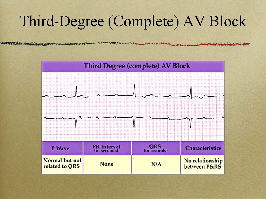 Third-Degree (Complete) AV Block 