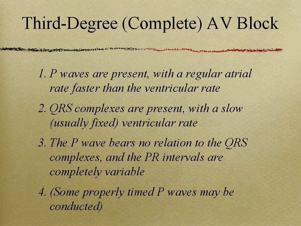 Third-Degree (Complete) AV Block 1. P waves are present, with a regular atrial rate