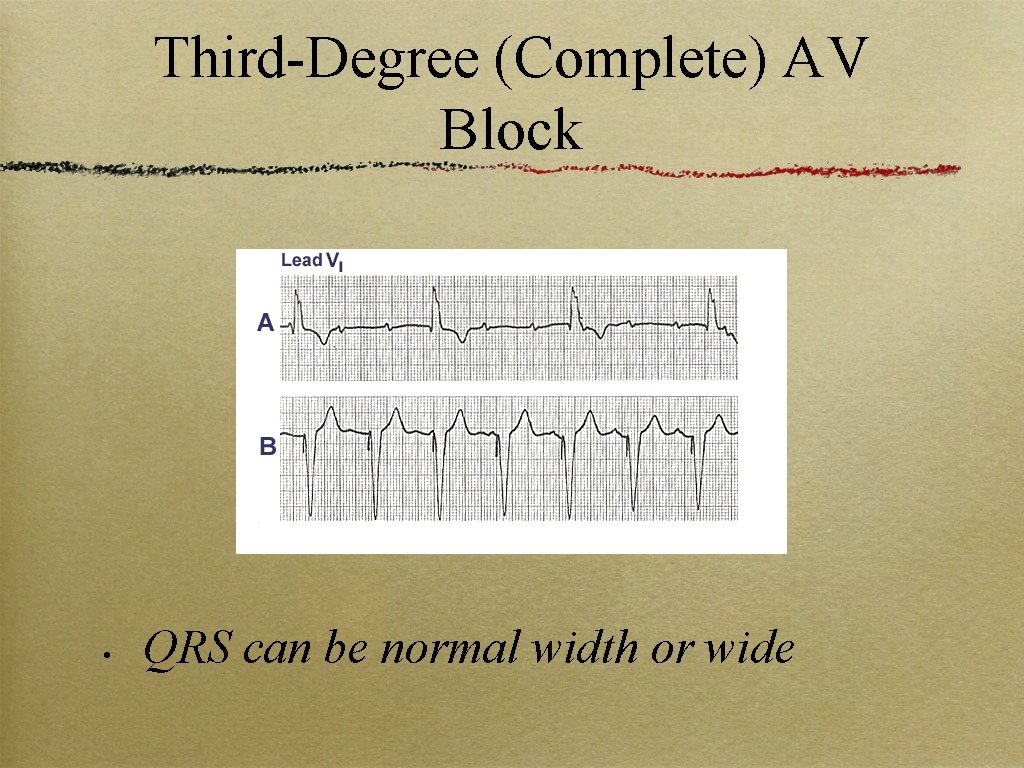 Third-Degree (Complete) AV Block • QRS can be normal width or wide 