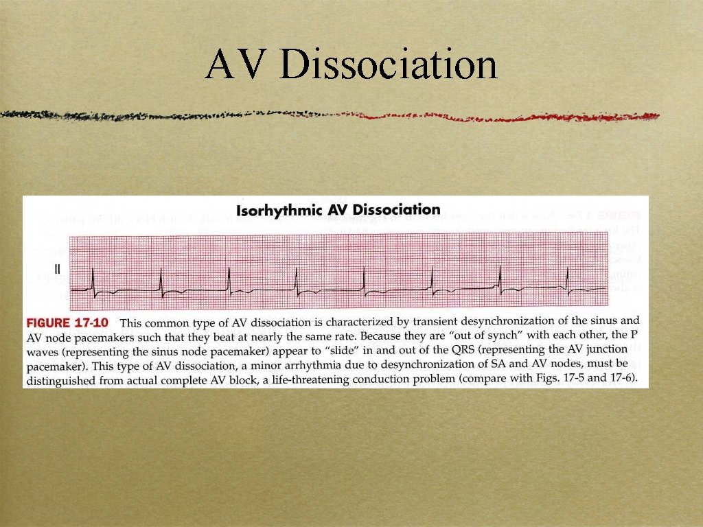 AV Dissociation 