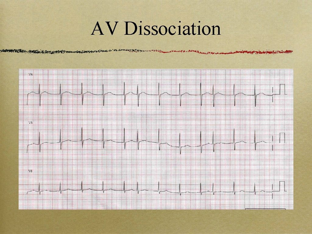 AV Dissociation 