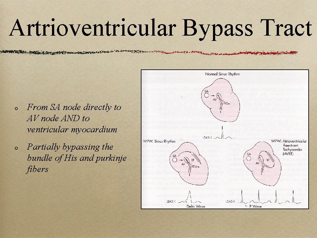 Artrioventricular Bypass Tract From SA node directly to AV node AND to ventricular myocardium