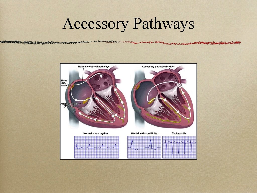 Accessory Pathways 