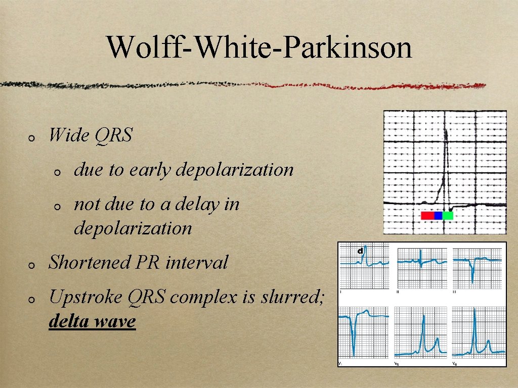 Wolff-White-Parkinson Wide QRS due to early depolarization not due to a delay in depolarization