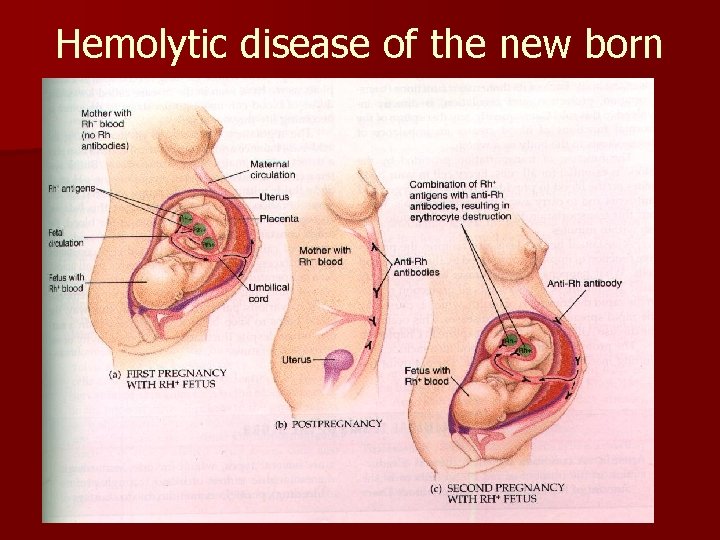 Hemolytic disease of the new born 