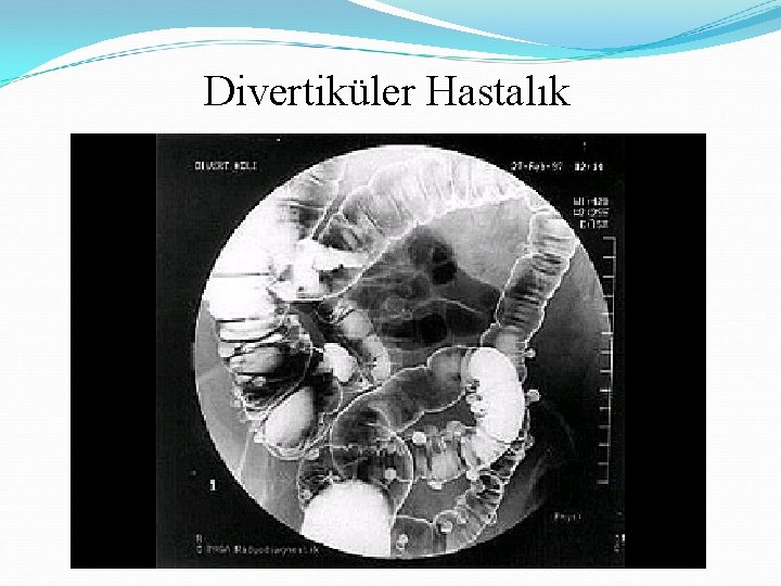 Divertiküler Hastalık 