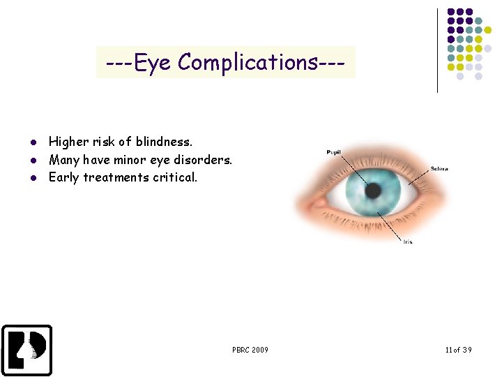 ---Eye Complications--- l l l Higher risk of blindness. Many have minor eye disorders.
