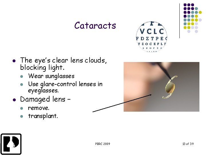 Cataracts l The eye’s clear lens clouds, blocking light. l l l Wear sunglasses