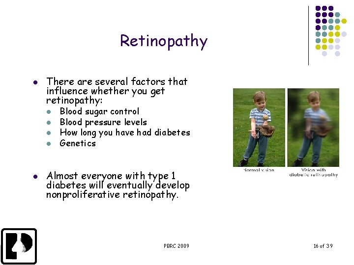 Retinopathy l There are several factors that influence whether you get retinopathy: l l